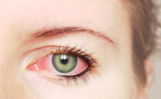 眼睑肿胀是红眼病的症状