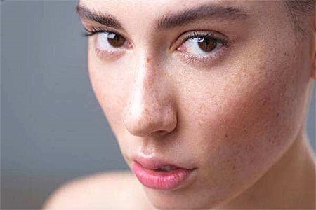 脸上长斑影响颜值，女性祛斑要知道色斑的类型