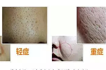 肌肤毛孔空隙的三种不同类型，女性都想了解的护肤小知识