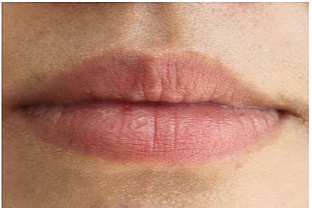 嘴唇上长水泡是什么原因，快速消除水泡的两个方法