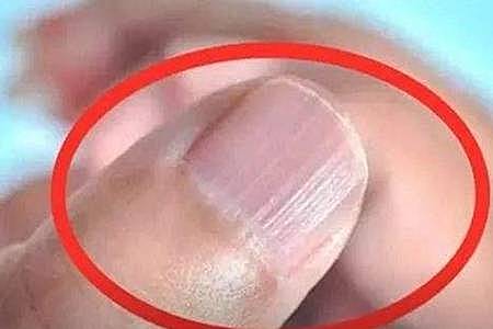 指甲上有竖纹是怎么回事？指甲竖纹多注意是疾病的征兆