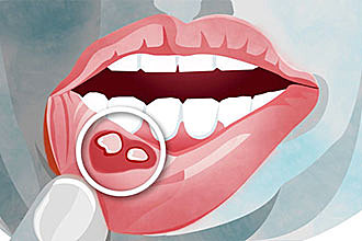 口腔溃疡影响进食？做好这四点避免复发